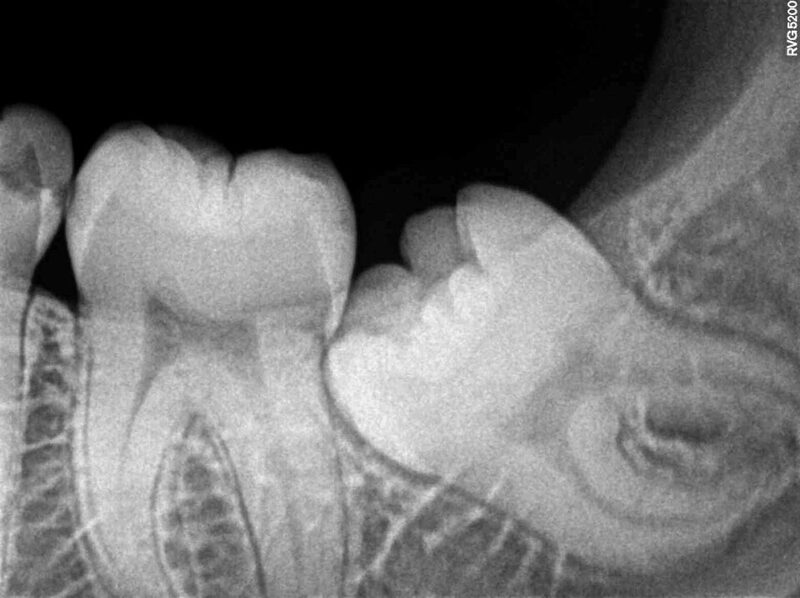 Radiografía de muela de juicio retenida (tercer molar inferior impactado)